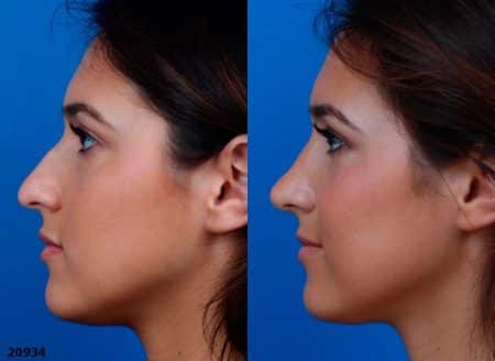 patient-12219-ethnic-rhinoplasty-before-after-6