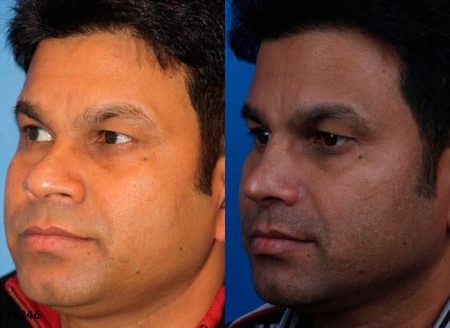 patient-12225-ethnic-rhinoplasty-before-after-2