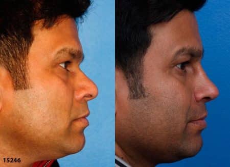 patient-12225-ethnic-rhinoplasty-before-after-3