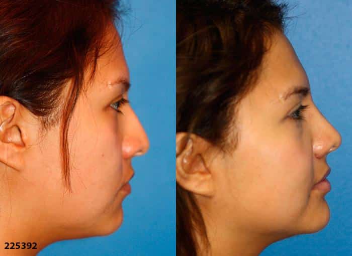 Ethnic rhinoplasty to refine the size and shape of the nose of a female patient by Dr. Miller. Surgery creates straighter nasal bridge and rotates tip for a more feminine profile.