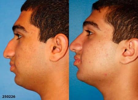 patient-12231-ethnic-rhinoplasty-before-after-1