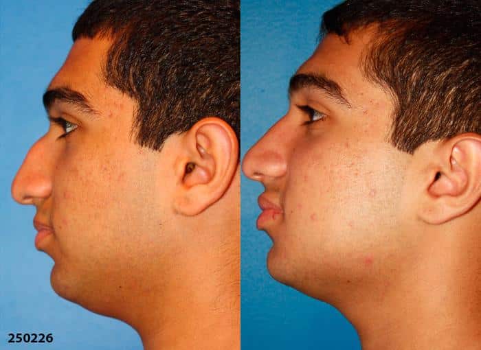 Ethnic rhinoplasty to improve the size and shape of the nose of a male patient by Dr. Miller. After surgery, dorsal hump is gone and tip is slightly rotated for a more aesthetically pleasing profile.