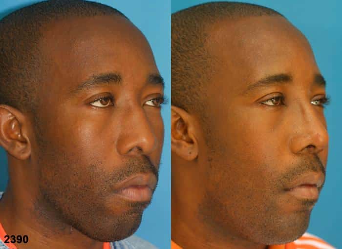 Ethnic rhinoplasty to improve the size and shape of the nose of a male patient by Dr. Miller. After surgery, nasal bridge is straighter and narrower, making it proportionate to other facial features.