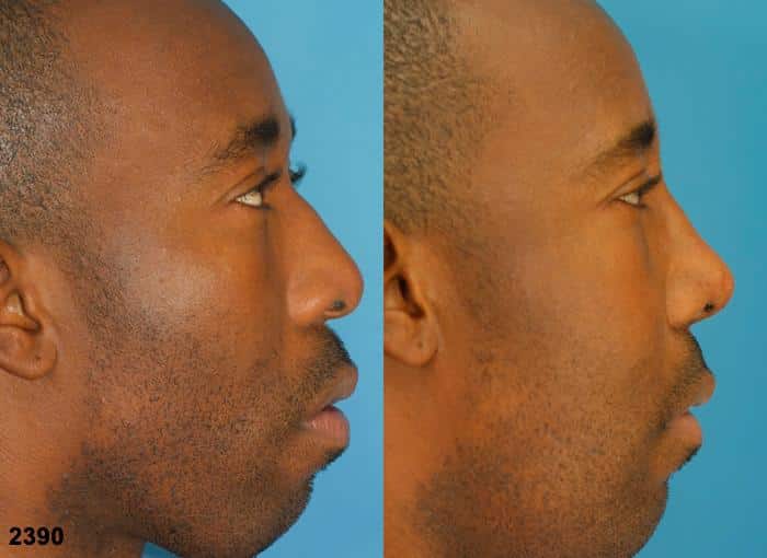 Ethnic rhinoplasty to improve the size and shape of the nose of a male patient by Dr. Miller. Procedure refines nasal bridge to create a more proportionate profile.