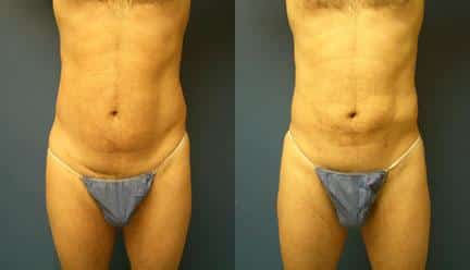 patient-12237-body-liposuction-before-after
