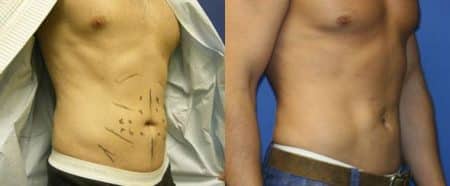 patient-12242-body-liposuction-before-after-1