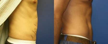 patient-12242-body-liposuction-before-after-2