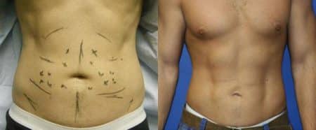 patient-12242-body-liposuction-before-after