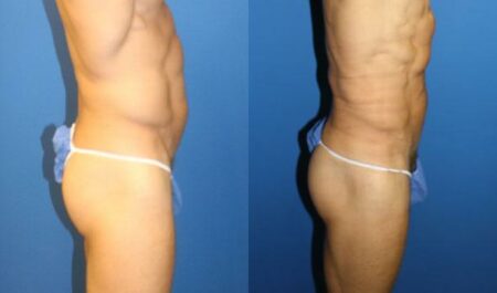 patient-12249-body-liposuction-before-after-1