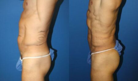 patient-12249-body-liposuction-before-after-2