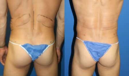 patient-12249-body-liposuction-before-after-3