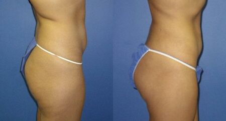 patient-12258-body-liposuction-before-after-1