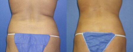 patient-12258-body-liposuction-before-after-2