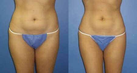 patient-12258-body-liposuction-before-after