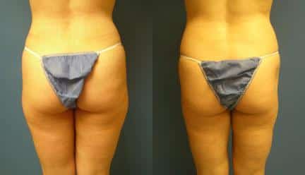 patient-12265-body-liposuction-before-after-1