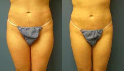 patient-12265-body-liposuction-before-after (1)