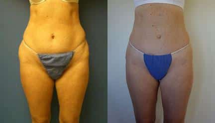 patient-12270-body-liposuction-before-after