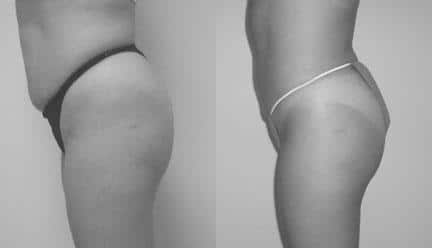 patient-12273-body-liposuction-before-after