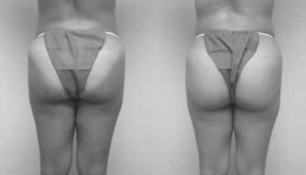 patient-12276-body-liposuction-before-after