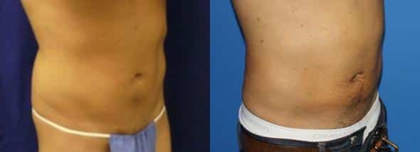 patient-12279-body-liposuction-before-after