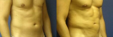 patient-12284-body-liposuction-before-after-1