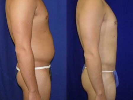 patient-12289-body-liposuction-before-after-2