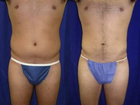 patient-12289-body-liposuction-before-after