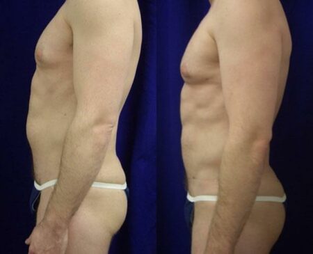 patient-12298-body-liposuction-before-after-2