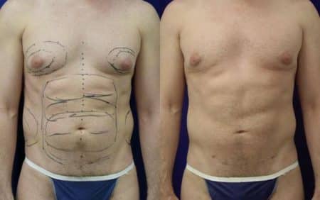 patient-12298-body-liposuction-before-after