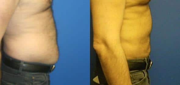 patient-12305-body-liposuction-before-after