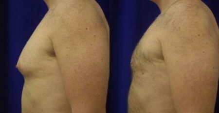 patient-12308-body-liposuction-before-after-3