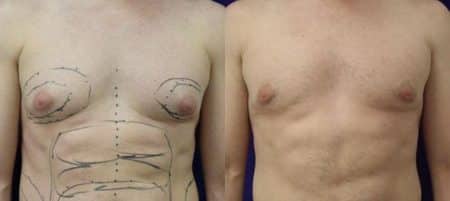 patient-12317-body-liposuction-before-after