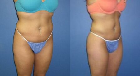 patient-12327-body-liposuction-before-after-1