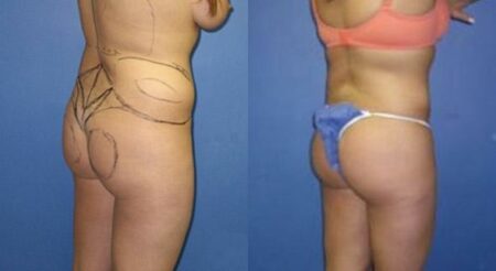 patient-12327-body-liposuction-before-after-2