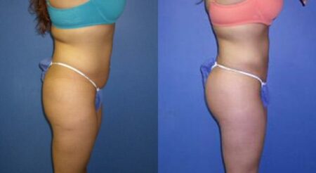 patient-12327-body-liposuction-before-after-3