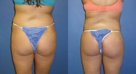 patient-12327-body-liposuction-before-after-4