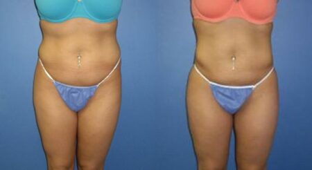 patient-12327-body-liposuction-before-after