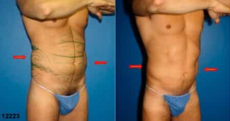 patient-12343-body-liposuction-before-after-1