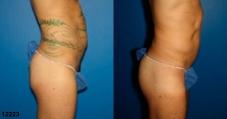 patient-12343-body-liposuction-before-after-3