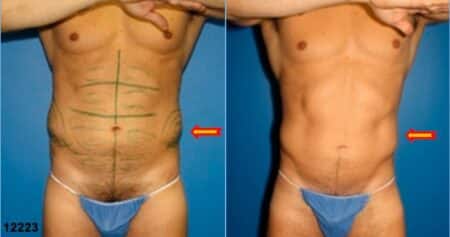 patient-12343-body-liposuction-before-after