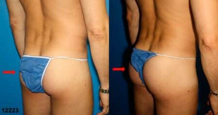 patient-12343-body-liposuction-before-after-5