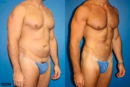 patient-12358-body-liposuction-before-after-1