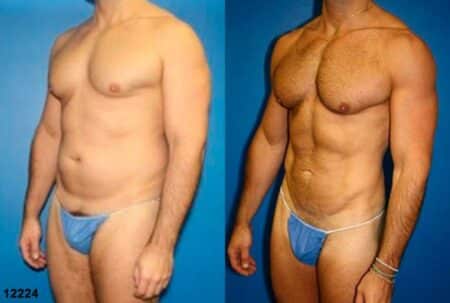 patient-12358-body-liposuction-before-after-2