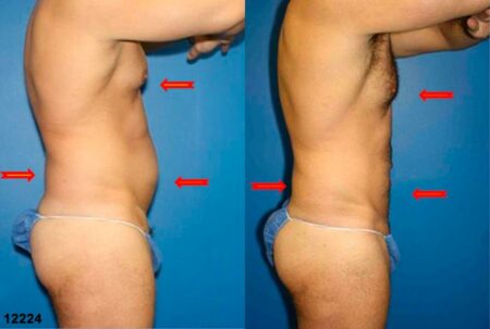 patient-12358-body-liposuction-before-after-3