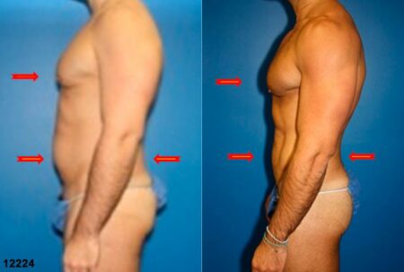 patient-12358-body-liposuction-before-after-4