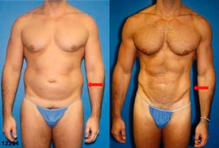 patient-12358-body-liposuction-before-after