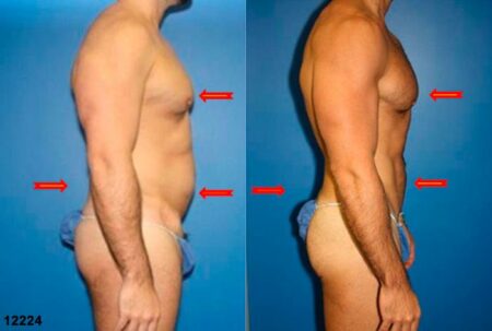 patient-12358-body-liposuction-before-after-5