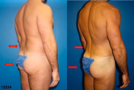 patient-12358-body-liposuction-before-after-6