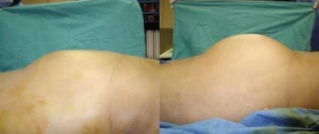 patient-12373-gluteal-augmentation-before-after