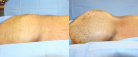 patient-12379-gluteal-augmentation-before-after